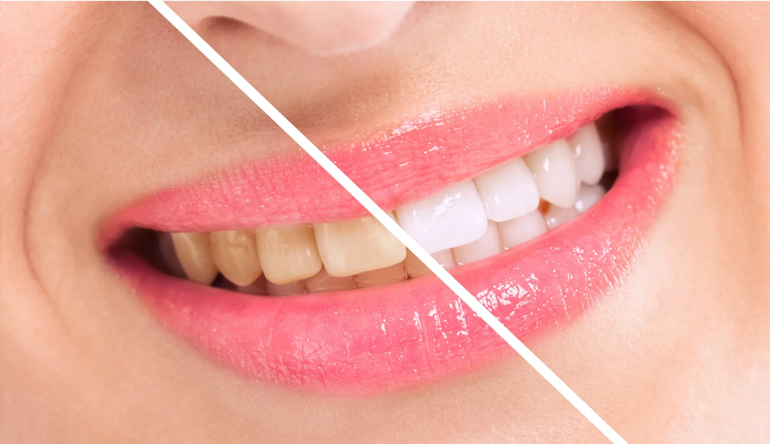 29919 teeth whitening surgery overview
