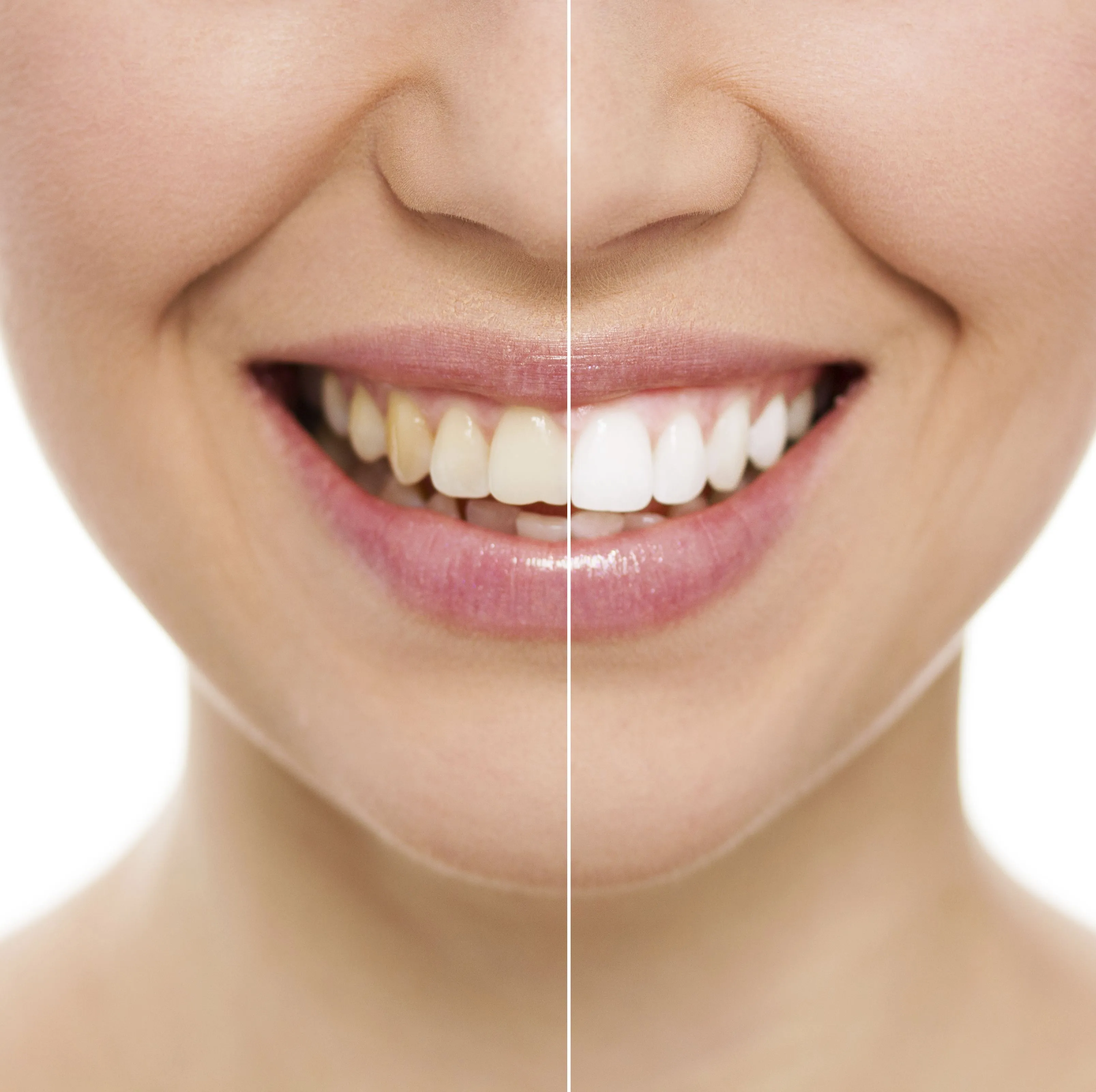 29932 teeth whitening naperville oral health