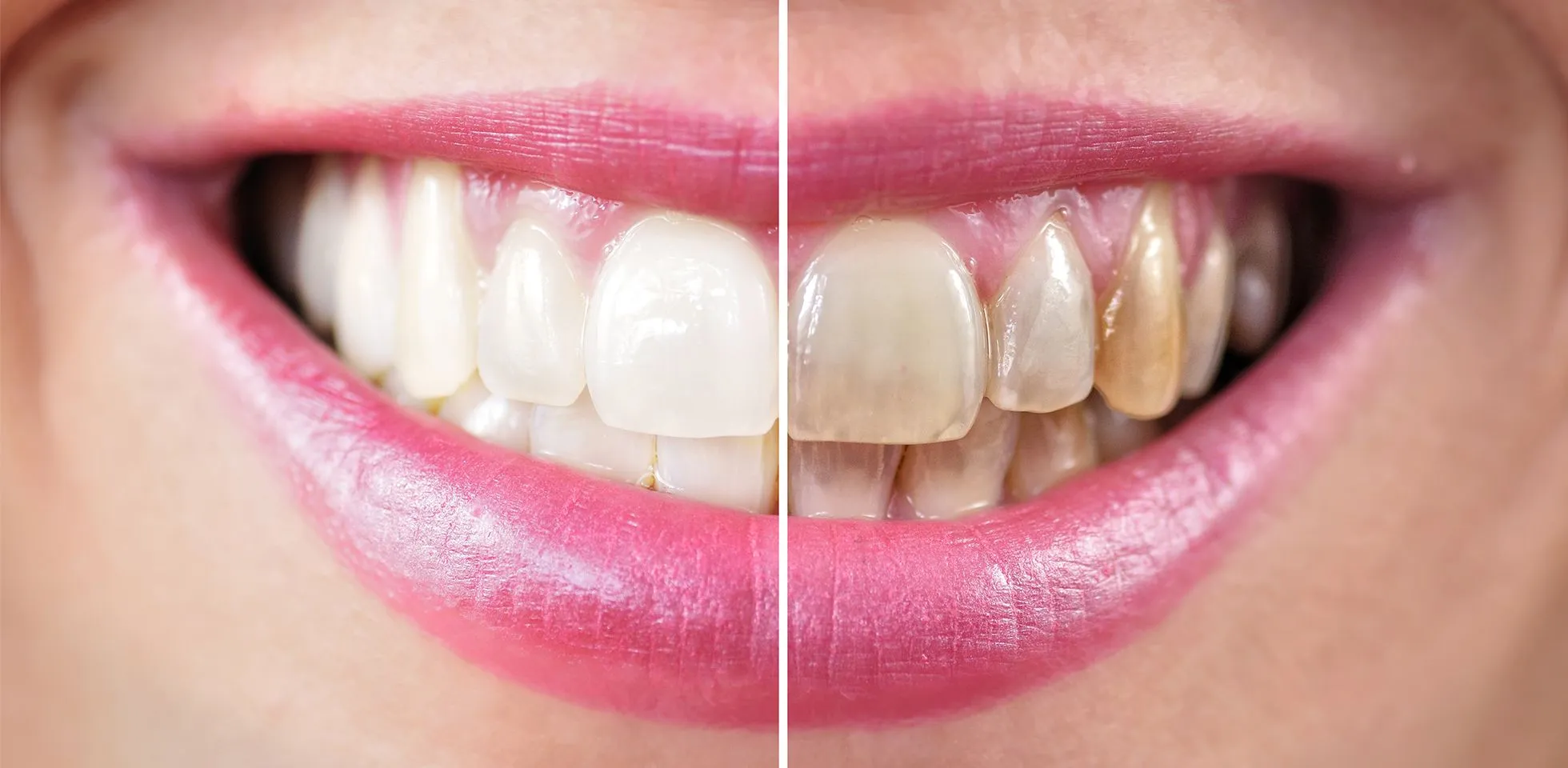 29932 teeth whitening naperville smile