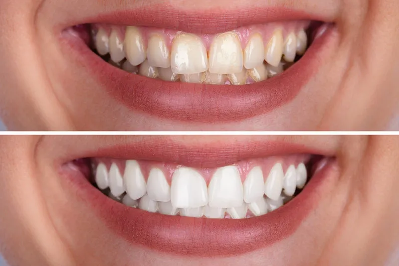 29937 internal teeth whitening before after