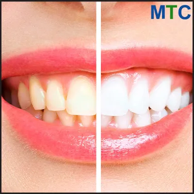 29938 teeth whitening aftercare