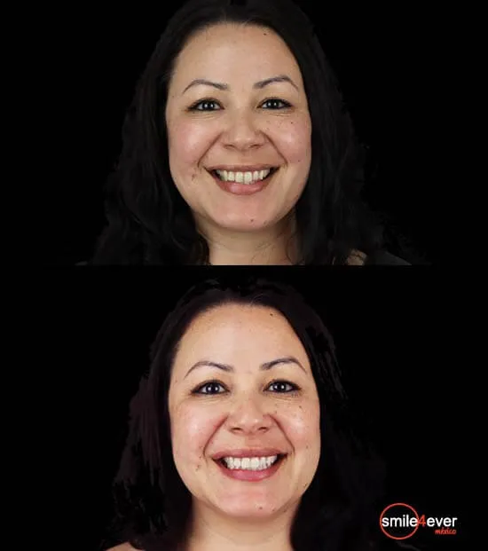 29938 teeth whitening kit