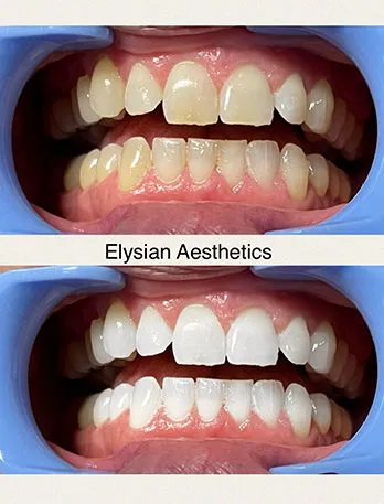 29940 da vinci laser whitening application