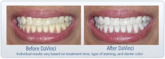 29940 da vinci teeth whitening consultation