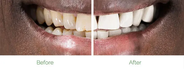 29942 in office teeth whitening
