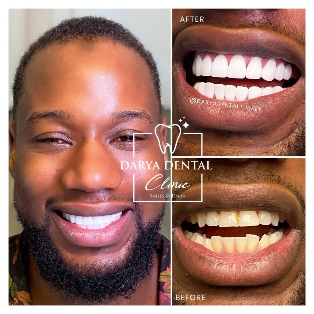 29942 take home whitening trays