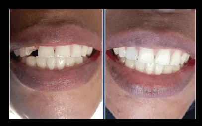 29942 teeth whitening dar es salaam overview