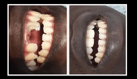 29942 whitening strips