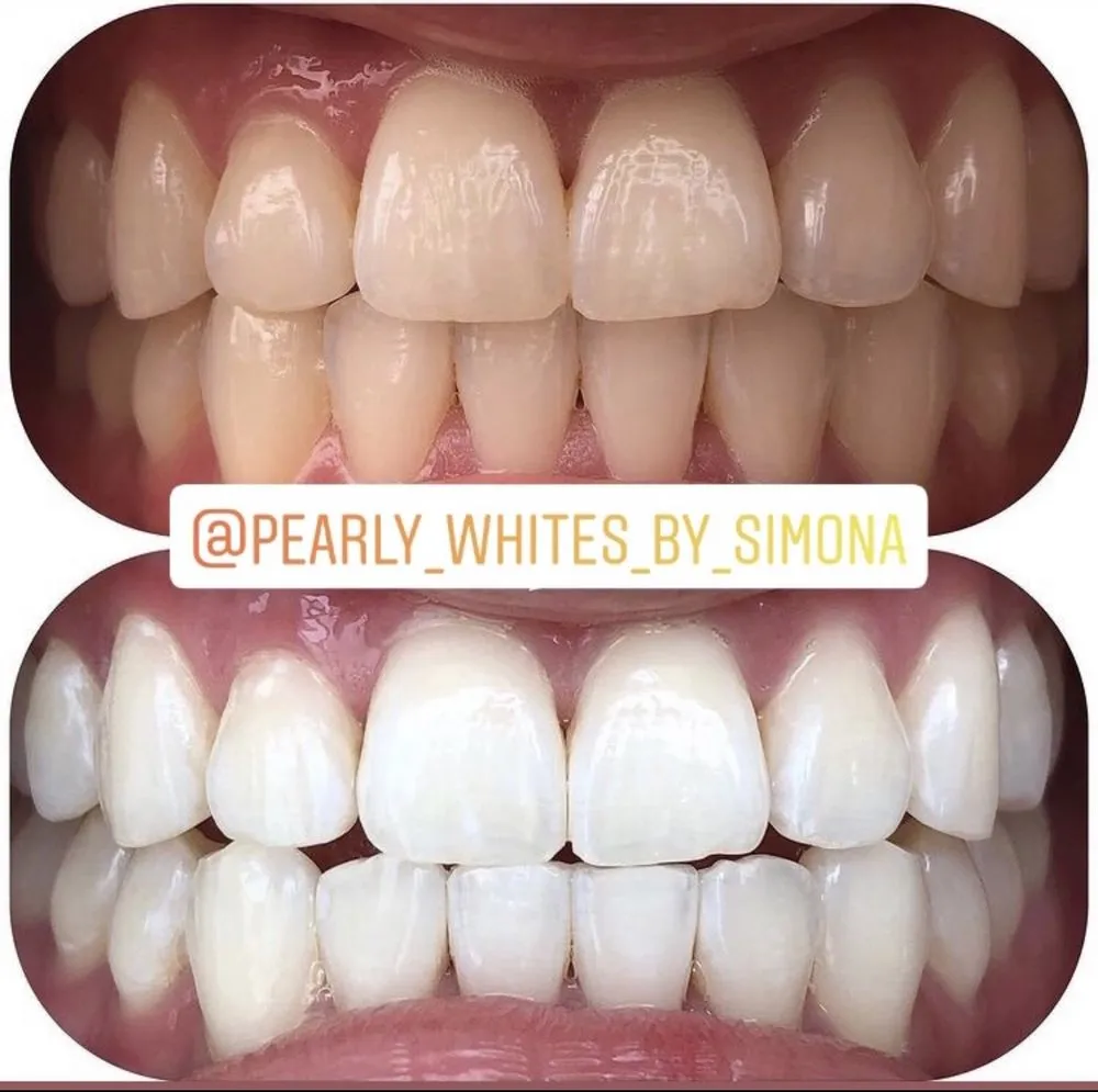 29944 long lasting teeth whitening