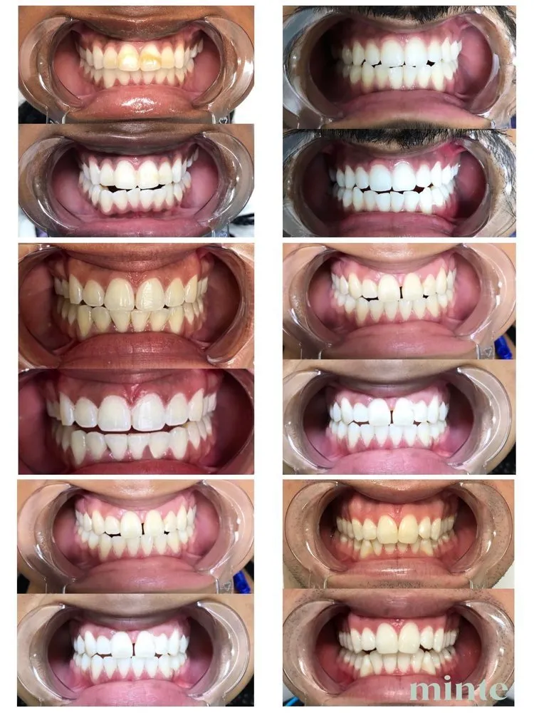 29952 mint teeth whitening side effects