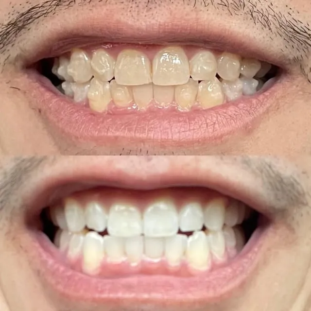 29955 professional teeth whitening