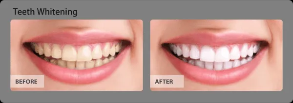 /img/29958-affordable-teeth-whitening.webp