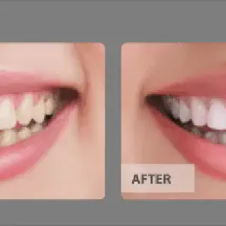 /img/29958-affordable-teeth-whitening.webp