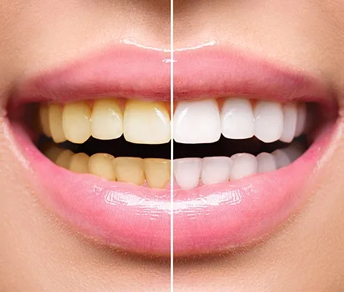 29958 teeth whitening cost reno