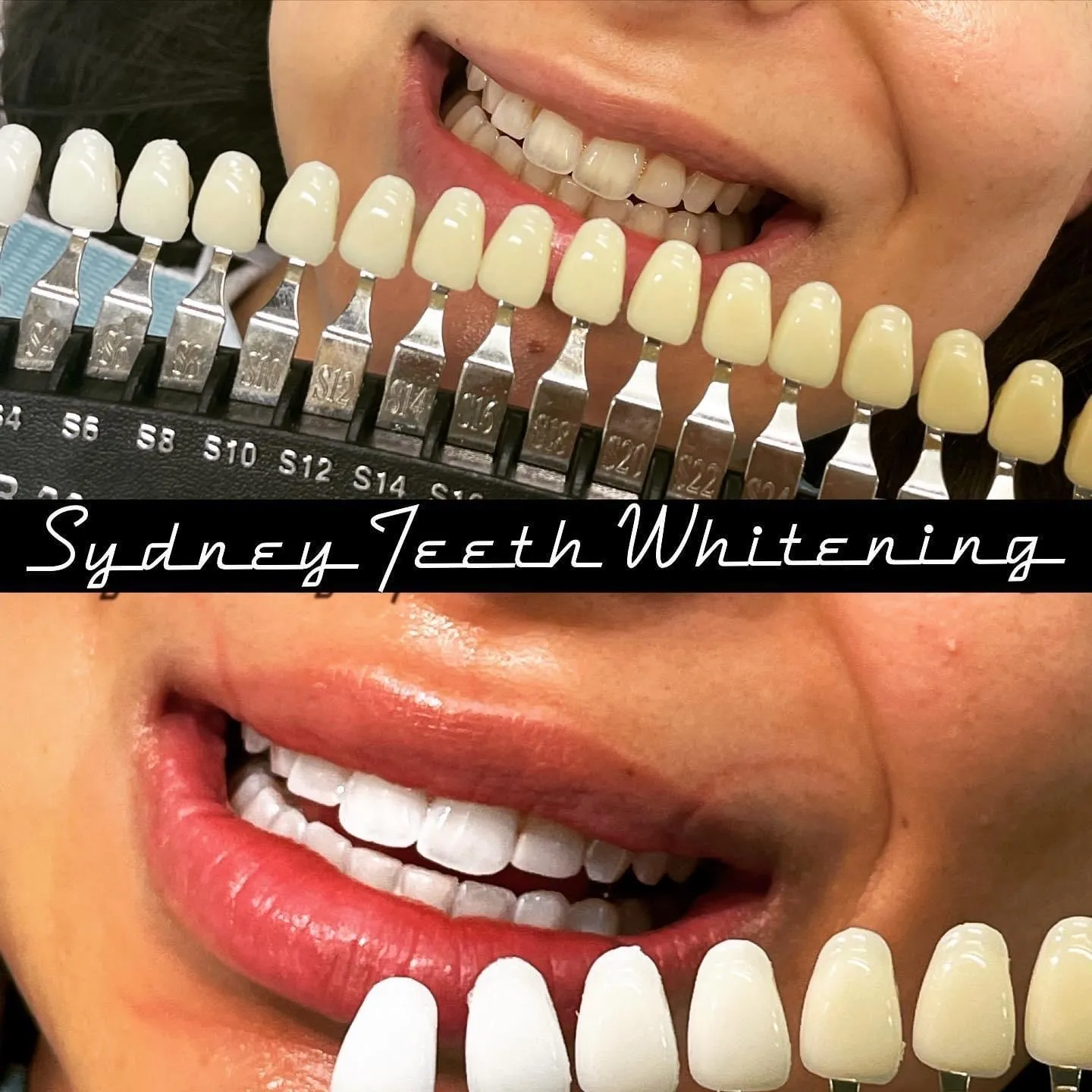 29959 aftercare teeth whitening