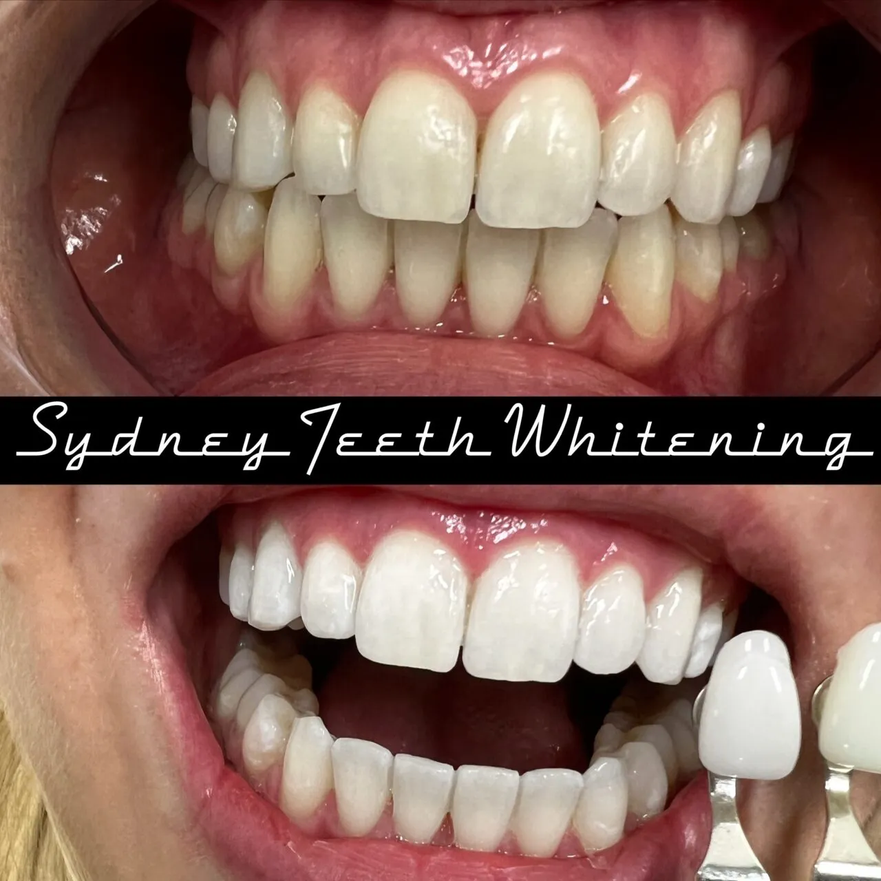 29959 in office teeth whitening