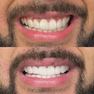 /img/29959-teeth-whitening-comparison.webp