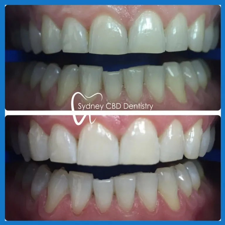 29959 teeth whitening cost factors