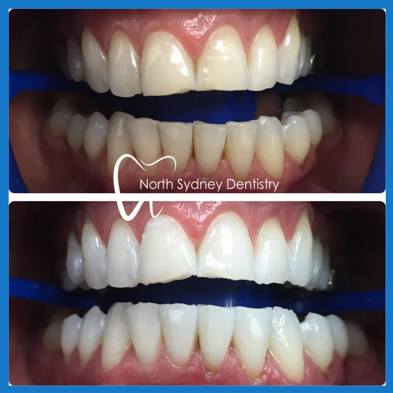 29959 teeth whitening sydney clinic