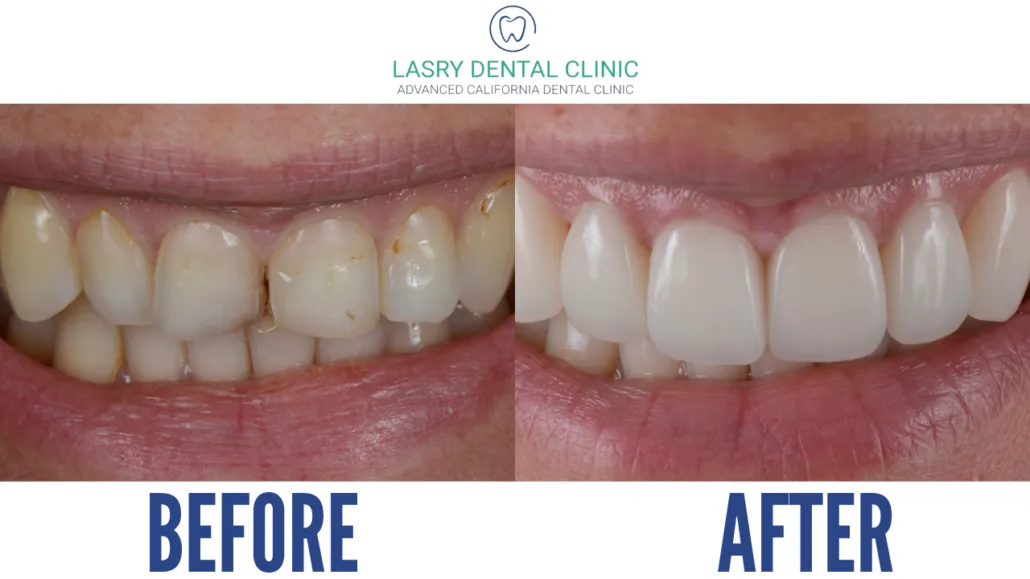 29961 coffee stain teeth