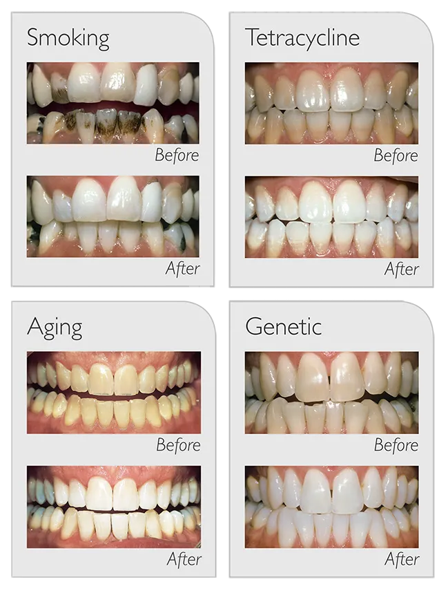 29961 tea stain teeth