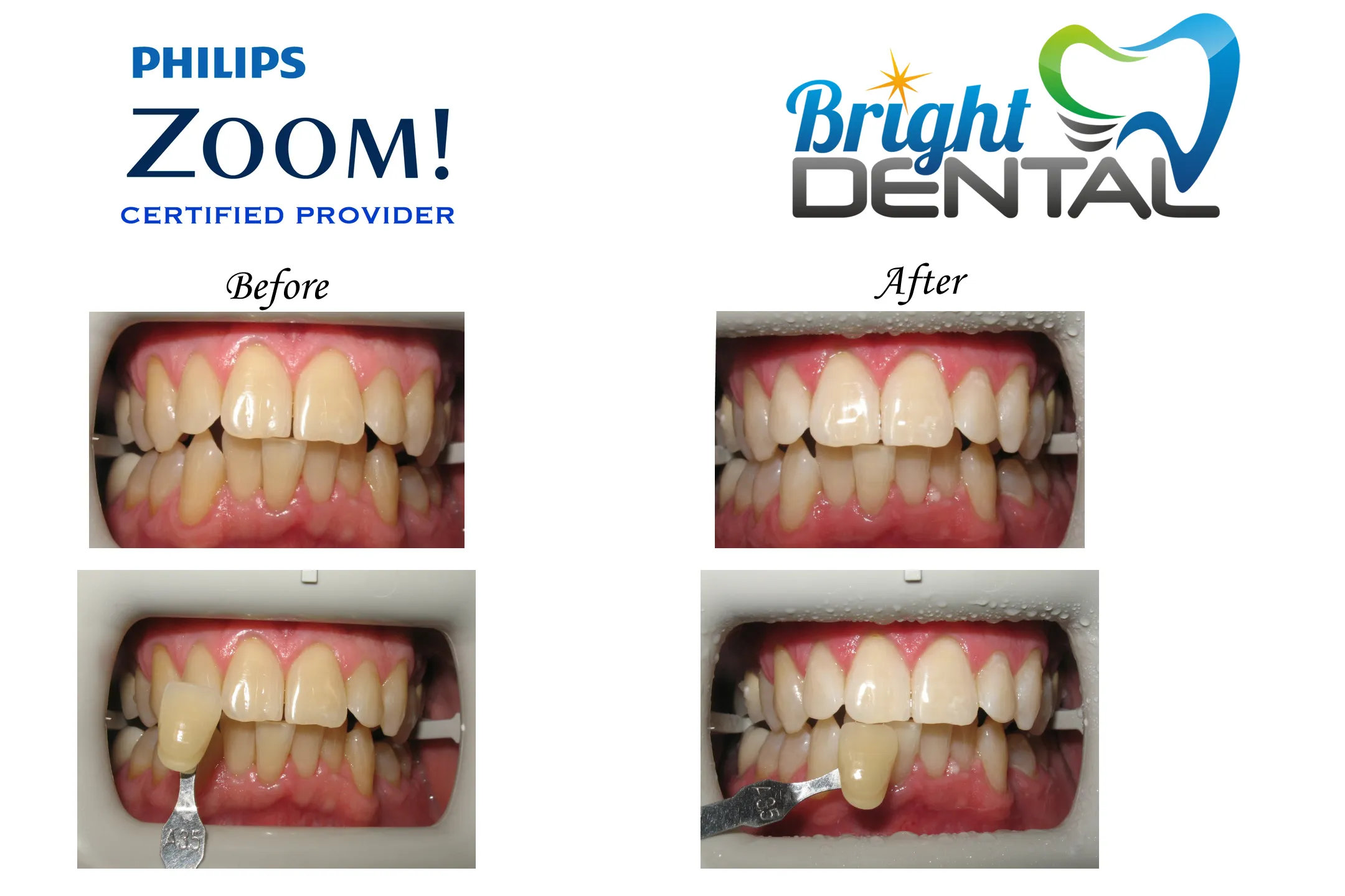 29961 whitening maintenance