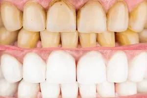 29963 whitening trays