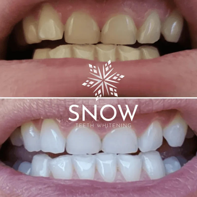 29971 snow teeth whitening science