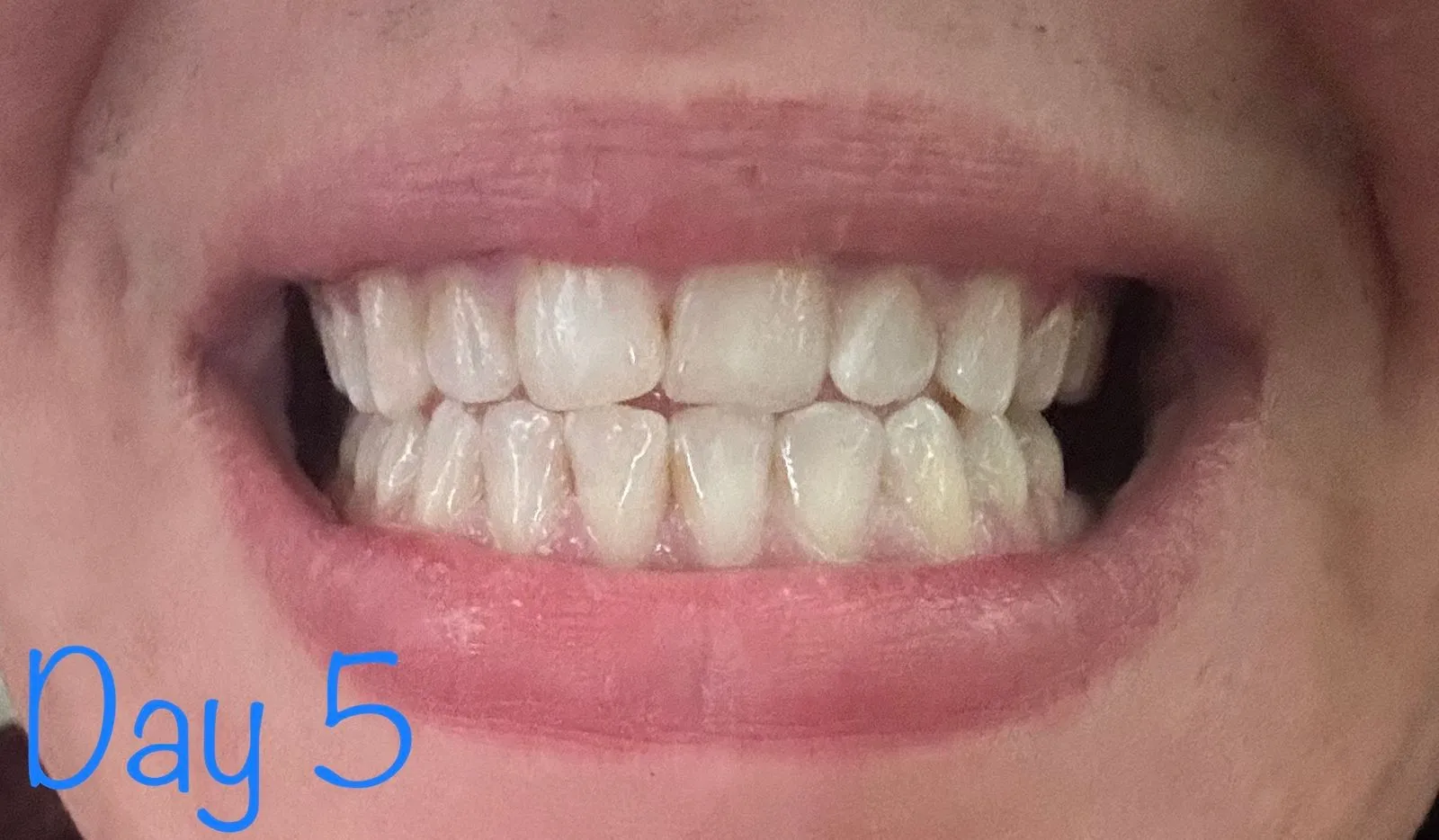 29971 teeth whitening alternatives