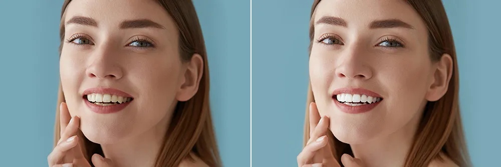 29973 professional teeth whitening