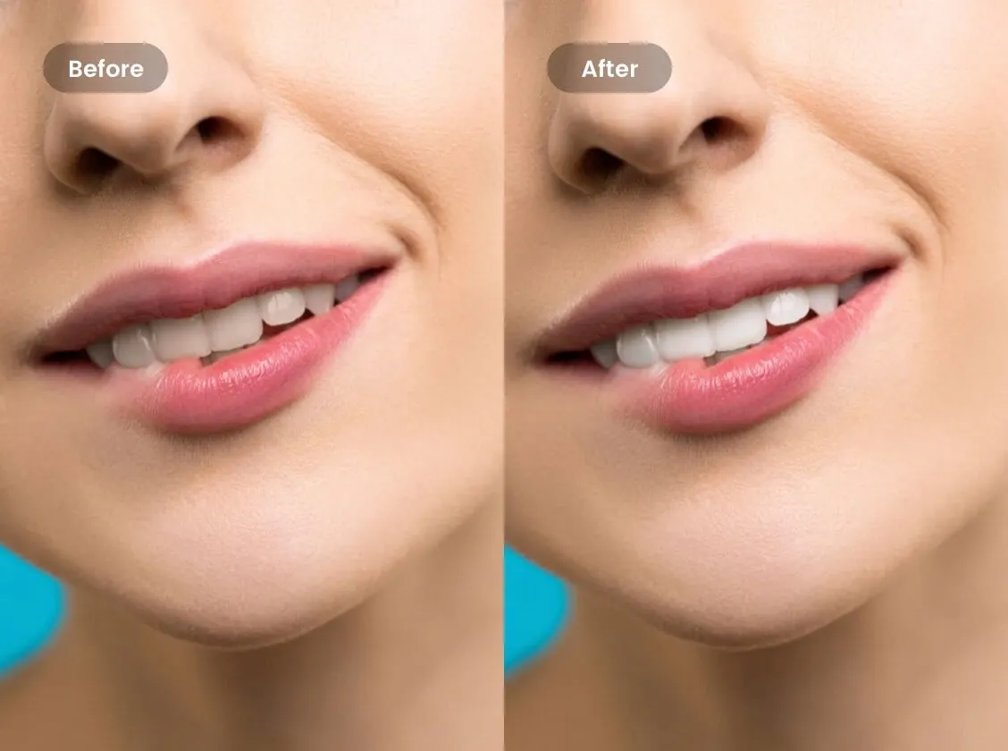 29973 teeth whitening overview