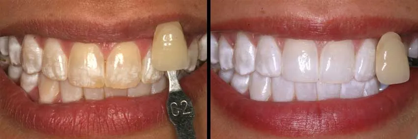 29978 existing dental issues