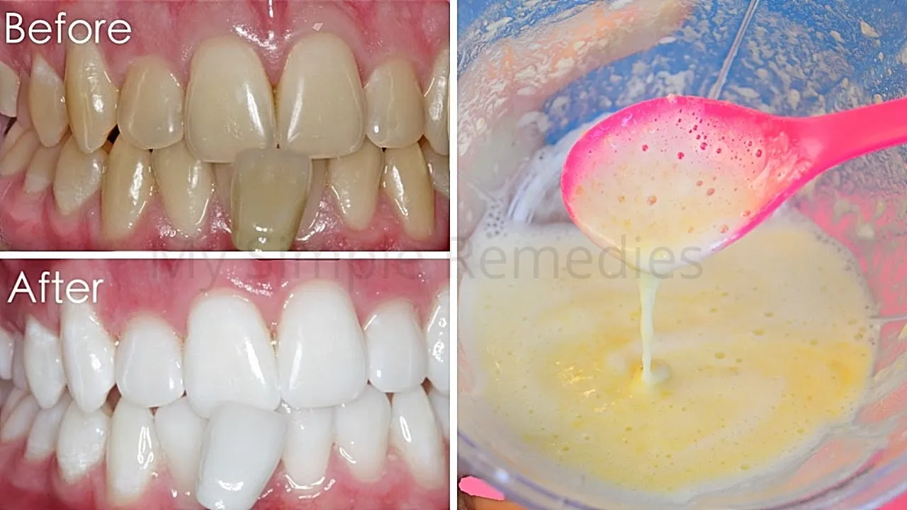 29981 at home teeth whitening