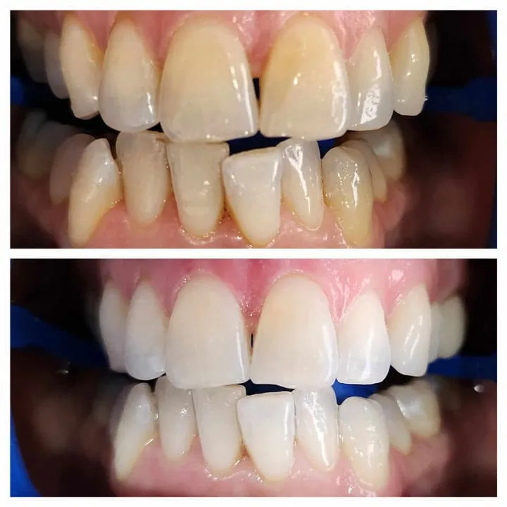 29982 adelaide teeth whitening clinic