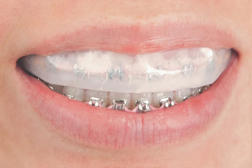 29983 sensitivity teeth braces