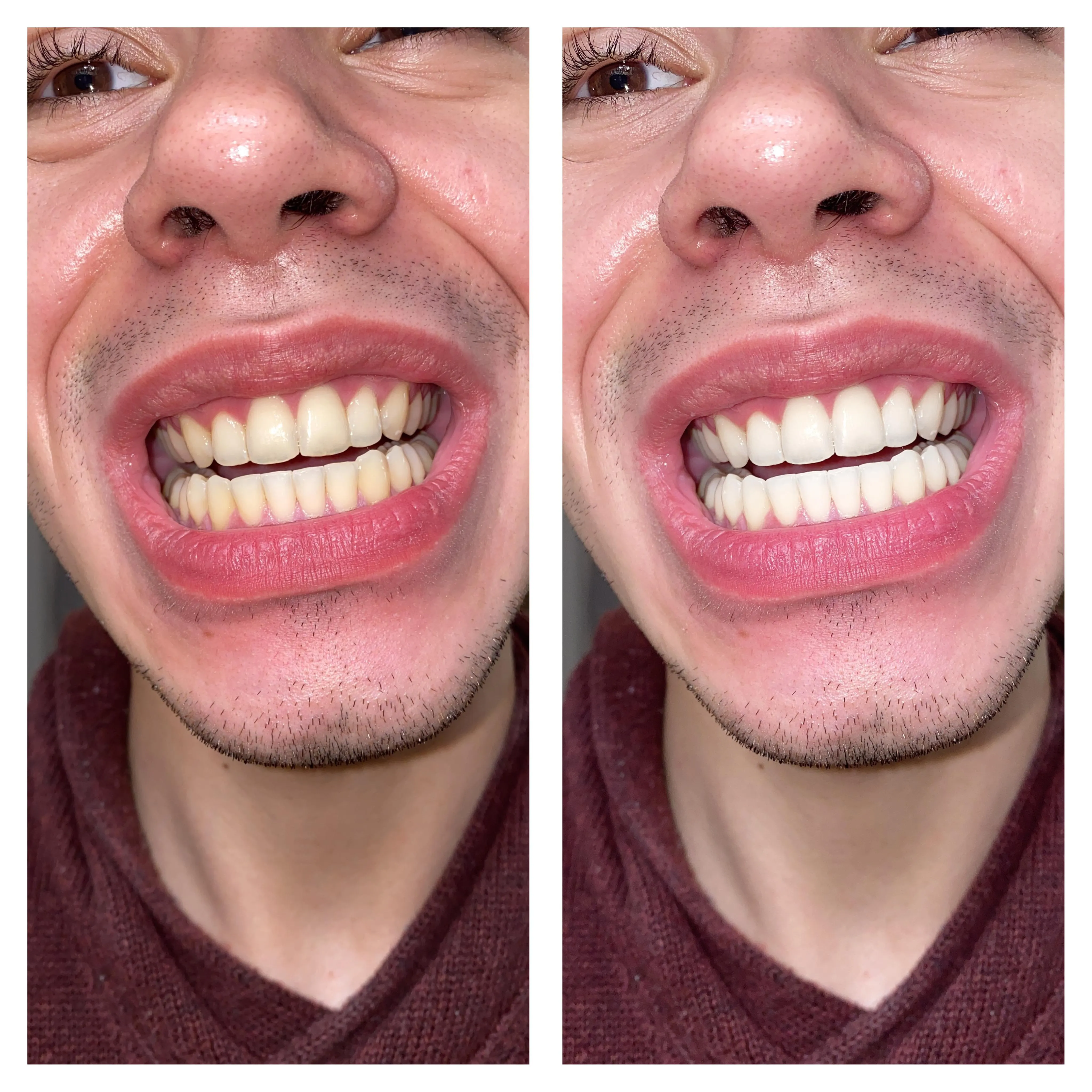 29983 whitening strip application