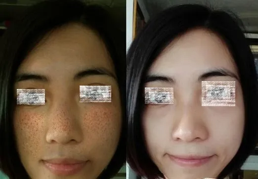 29984 chemical peels dubai