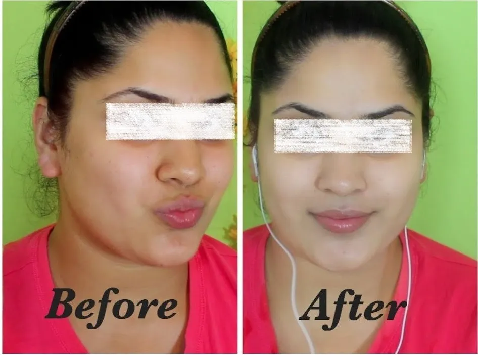 29984 microdermabrasion dubai