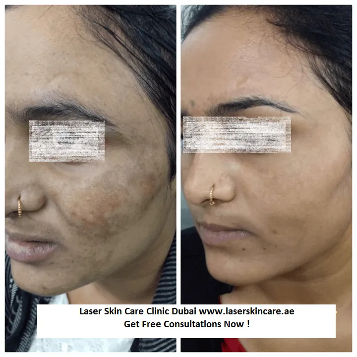 29984 skin whitening dubai consultation