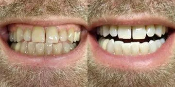 29988 teeth sensitivity