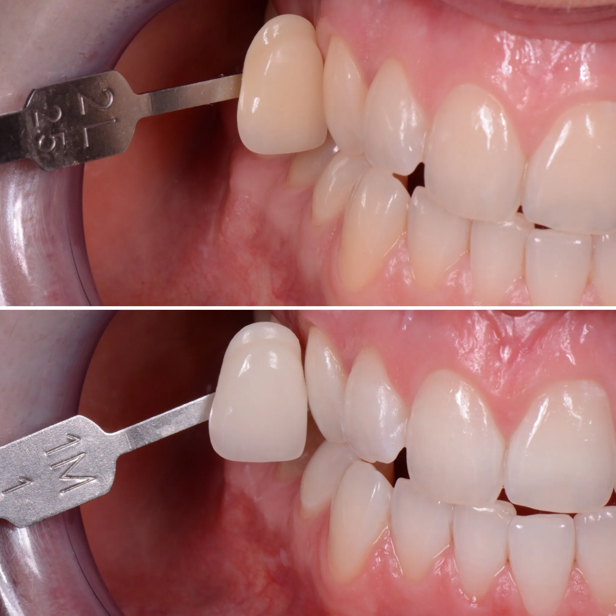 29988 zoom whitening