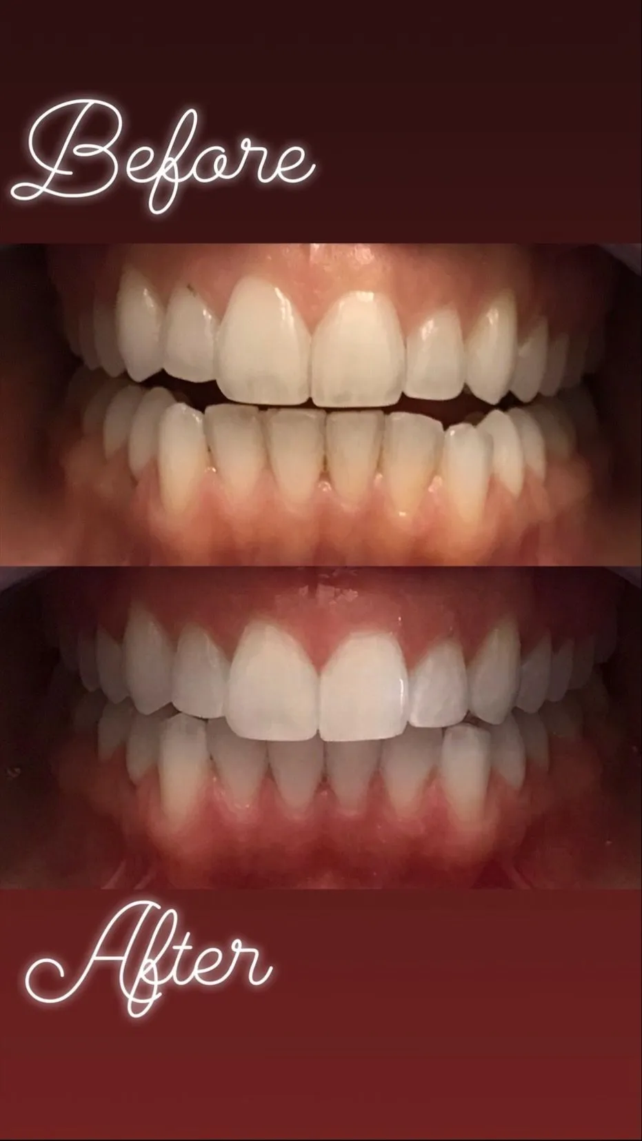 29991 cavities and teeth whitening 6