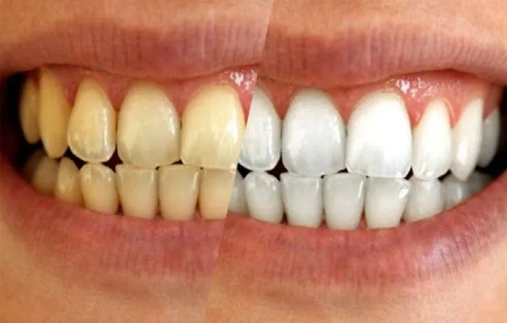 29991 cavities and teeth whitening 7
