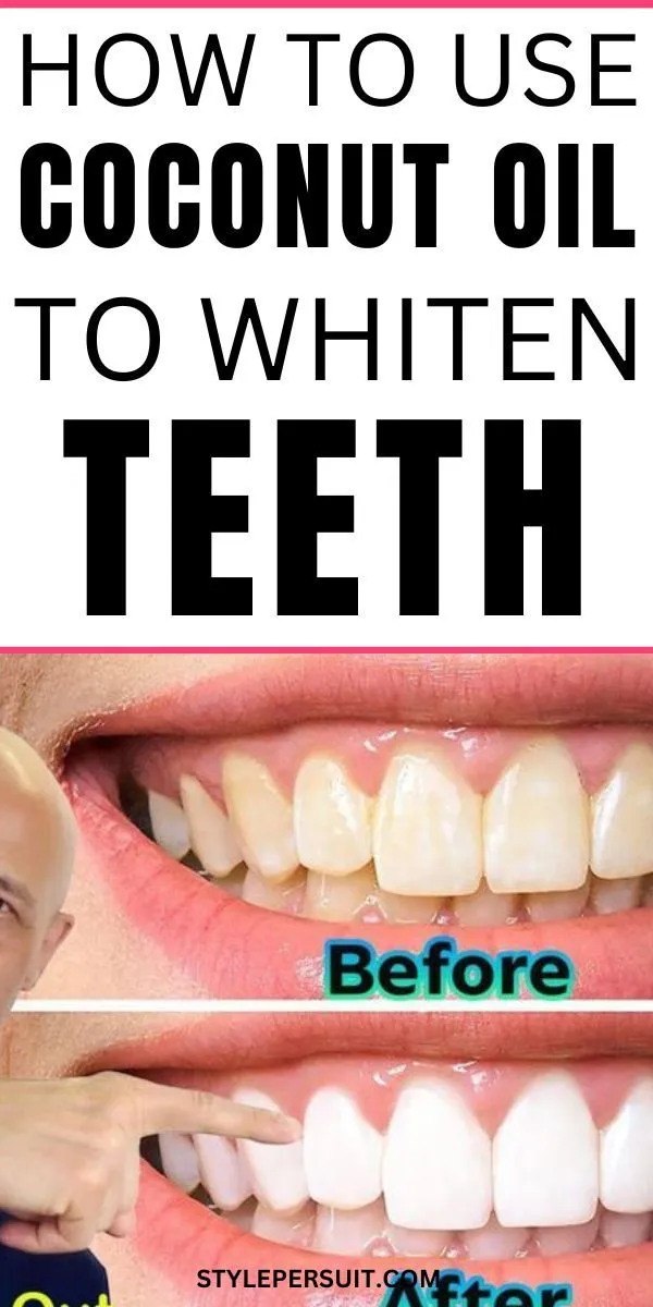 /img/29991-cavities-and-teeth-whitening-8.webp
