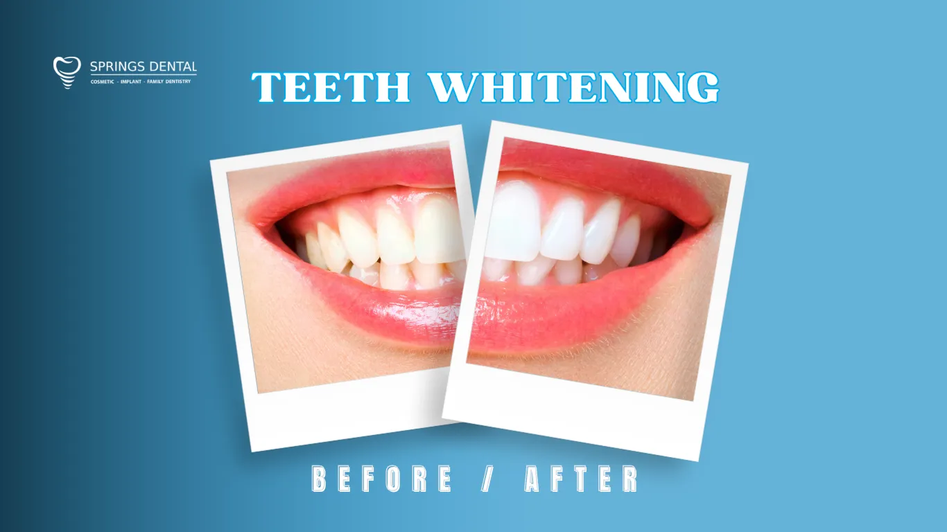 29992 professional teeth whitening