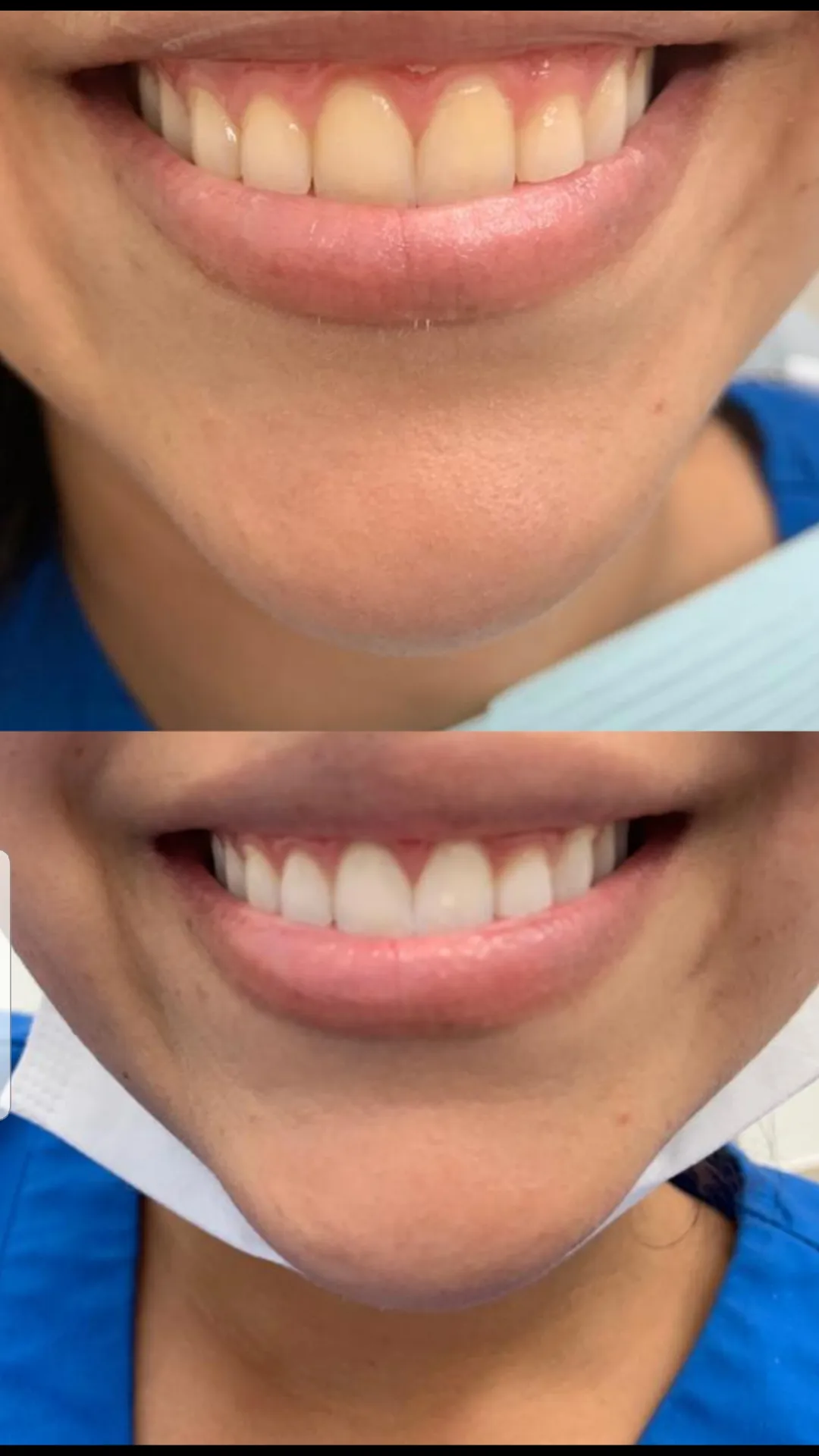 29992 teeth whitening miami