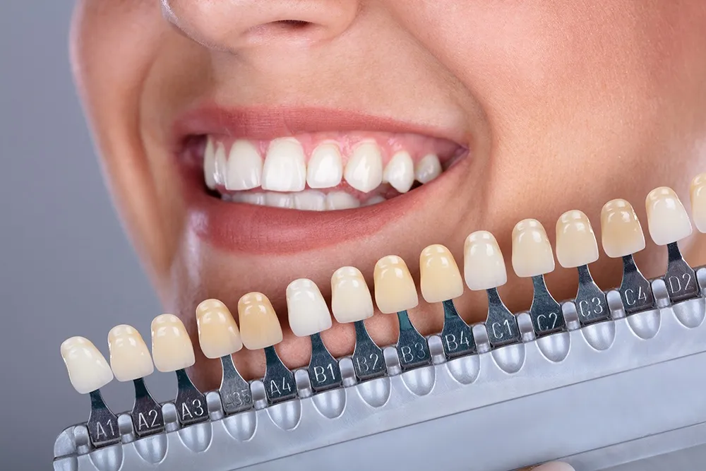 29994 teeth whitening results