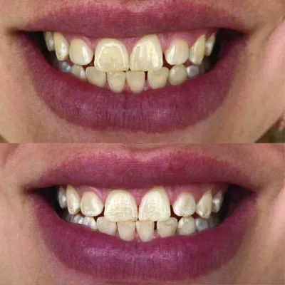 29996 teeth sensitivity