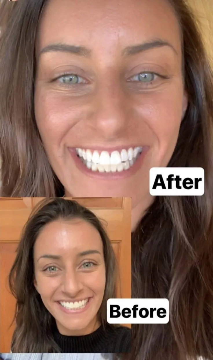 29996 teeth stains removal