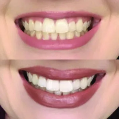 29996 whitening strips application